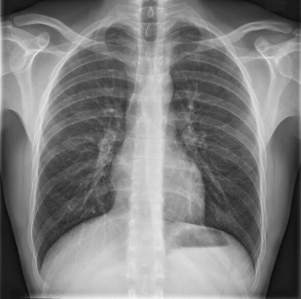 Rindkere lülisamba osteokondroosi diagnoosimine toimub radiograafia abil