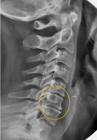 Emakakaela lülisamba osteokondroos x -ray