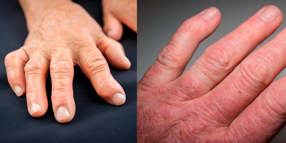 käte reumatoid- ja psoriaatiline artriit