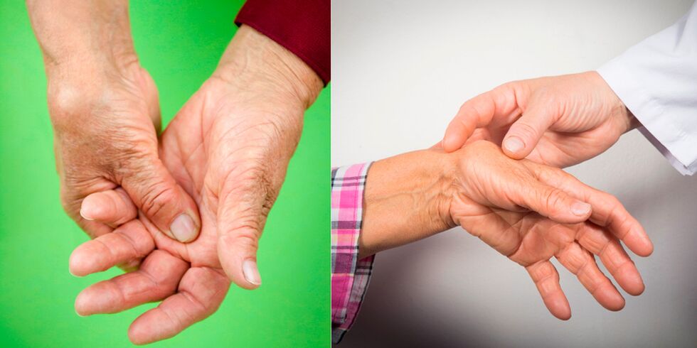 tursed ja valutavad valud on käte artriidi esimesed tunnused